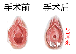 处女膜修复前后对比图